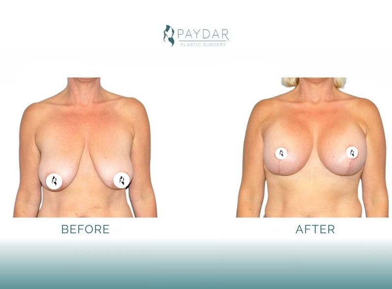 Photo by Keyian Paydar, MD FACS on July 10, 2026. May be an image of bra and text that says 'PAYDAR PLASTICSURGERY PLASTIC SURGERY 々 な 4 BEFORE AFTER'.