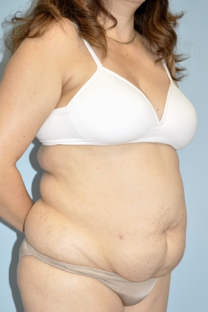 Patient Liposuction Before 1