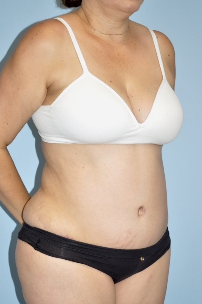 Patient Liposuction Before 1