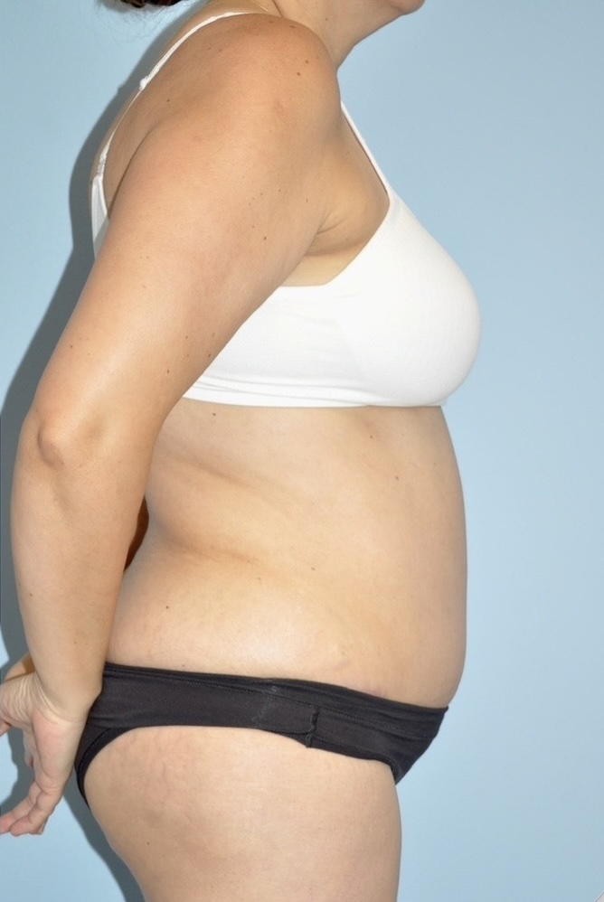 Patient Liposuction Before 2