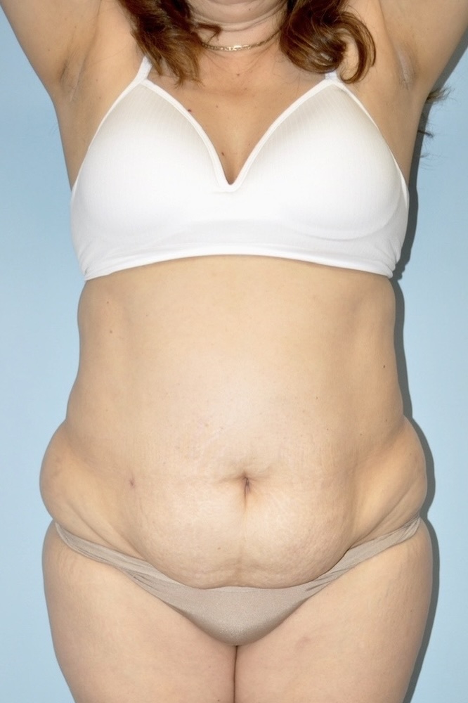 Patient Liposuction Before 3