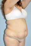 Patient Liposuction Thumbnail Before 4