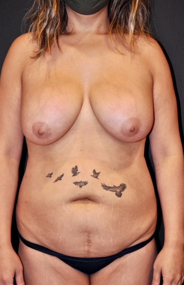 Patient Mommy Makeover Before 0