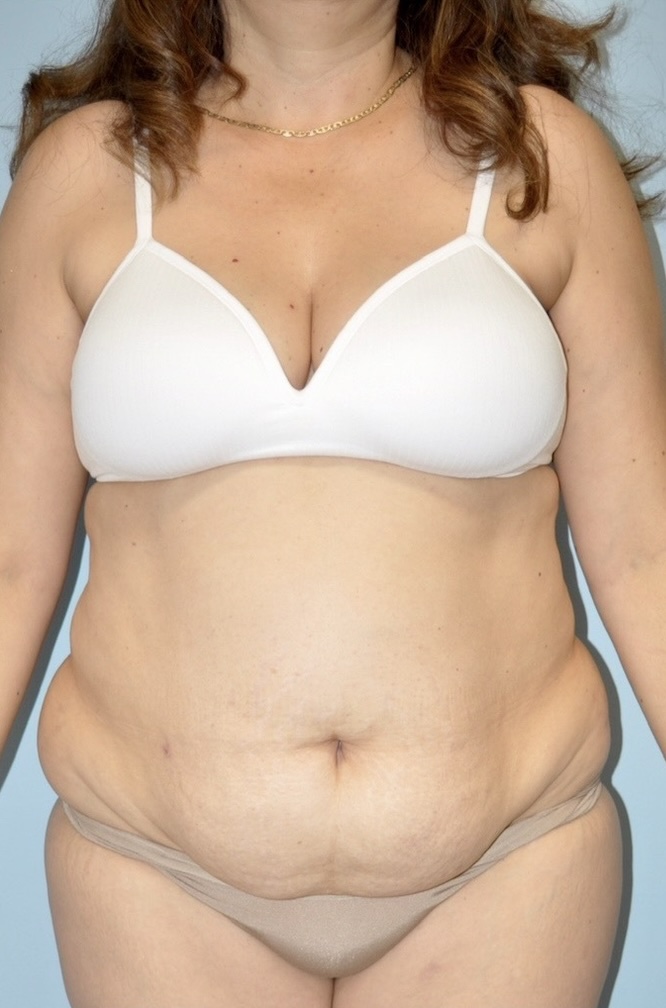 Patient Tummy Tuck Before 0