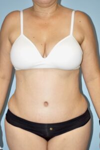 Patient Body After 0