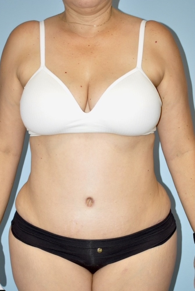 Patient Tummy Tuck Before 0