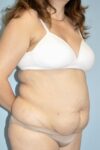 Patient Tummy Tuck Thumbnail Before 1