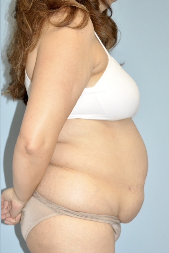 Patient Tummy Tuck Before 2