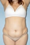 Patient Tummy Tuck Thumbnail Before 3