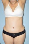 Patient Tummy Tuck Thumbnail After 3