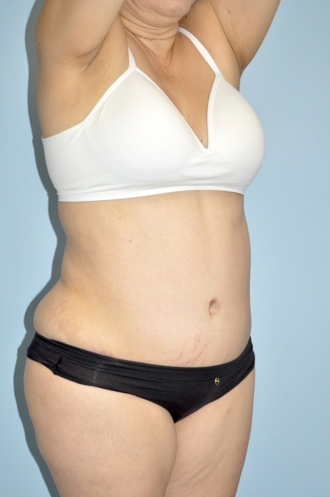 Patient Tummy Tuck Before 4