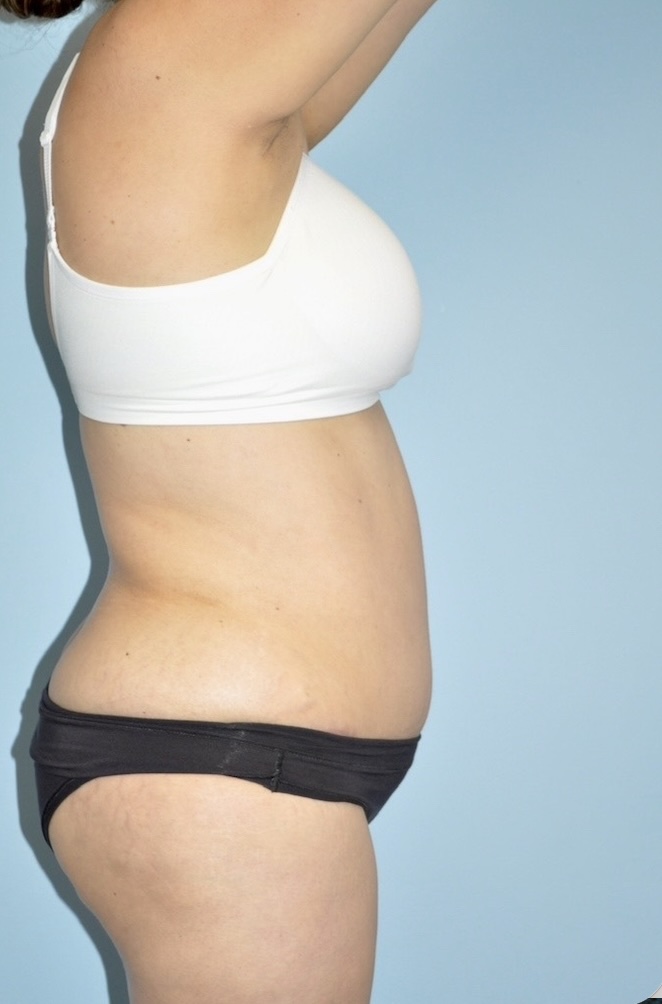 Patient Tummy Tuck Before 5